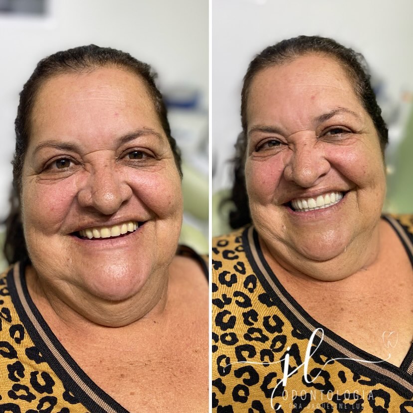 Transformação do Sorriso — antes e depois